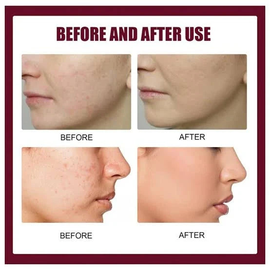 Niacinamide Serum For Acne, Pimples and Scar (Buy 1 Get 1 Free)