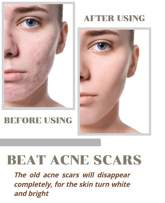 Niacinamide Serum For Acne, Pimples and Scar (Buy 1 Get 1 Free)