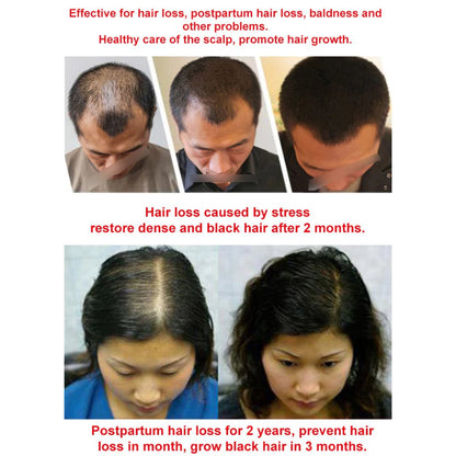 Japanese Natural Anti-Hair Fall Shampoo (Buy 1 Get 1 Free)